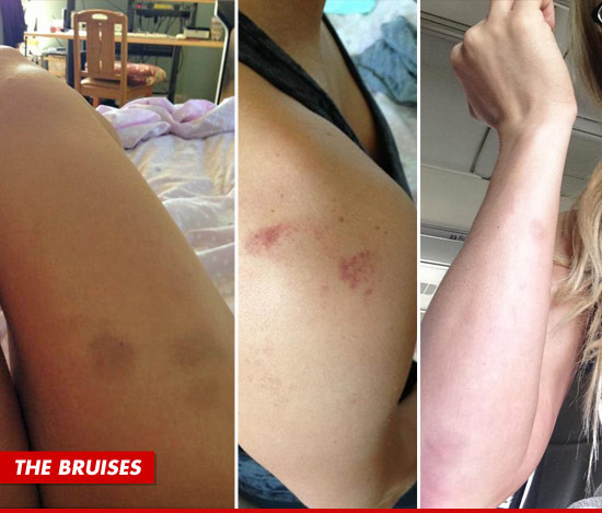 0604-taryn-terrell-bruises-1